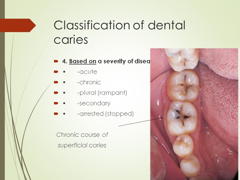 Classification of dental caries 4. Based on a severity of disease:  • -acute